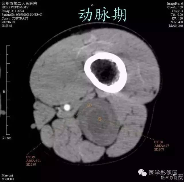 【病例】腘窝上方神经鞘瘤1例CT影像表现 【病例】腘窝上方神经鞘瘤1例CT影像表现