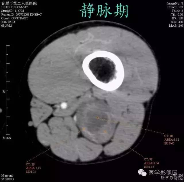 【病例】腘窝上方神经鞘瘤1例CT影像表现 【病例】腘窝上方神经鞘瘤1例CT影像表现