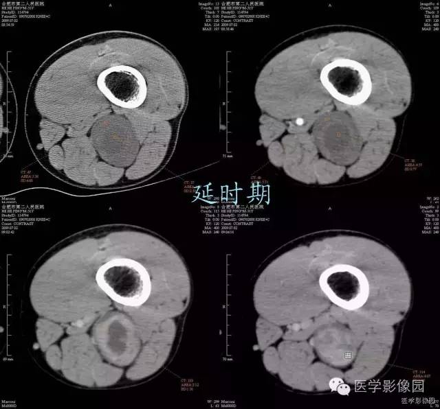 【病例】腘窝上方神经鞘瘤1例CT影像表现 【病例】腘窝上方神经鞘瘤1例CT影像表现