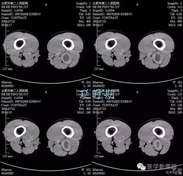 【病例】腘窝上方神经鞘瘤1例CT影像表现 【病例】腘窝上方神经鞘瘤1例CT影像表现