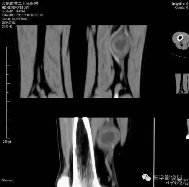 【病例】腘窝上方神经鞘瘤1例CT影像表现 【病例】腘窝上方神经鞘瘤1例CT影像表现