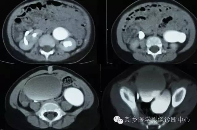 原发性非梗阻性巨输尿管
