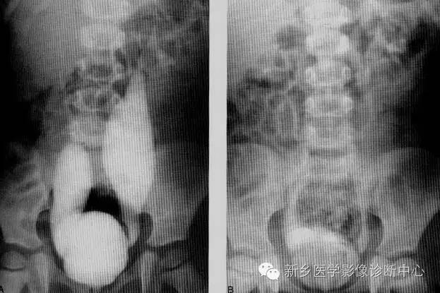 原发性非梗阻性巨输尿管 原发性非梗阻性巨输尿管