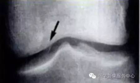 【病例】半月板小骨2例X线及MR影像表现 【病例】半月板小骨2例X线及MR影像表现