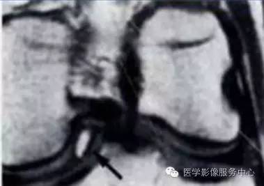 【病例】半月板小骨2例X线及MR影像表现 【病例】半月板小骨2例X线及MR影像表现