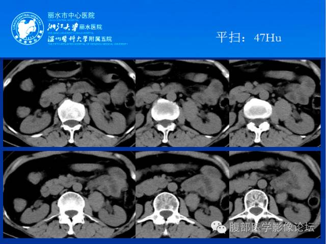【病例】肾平滑肌瘤1例CT影像表现 【病例】肾平滑肌瘤1例CT影像表现