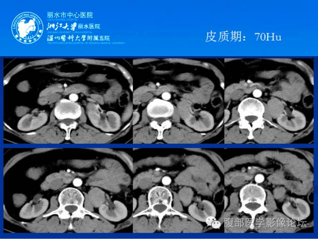 【病例】肾平滑肌瘤1例CT影像表现 【病例】肾平滑肌瘤1例CT影像表现