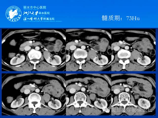 【病例】肾平滑肌瘤1例CT影像表现 【病例】肾平滑肌瘤1例CT影像表现