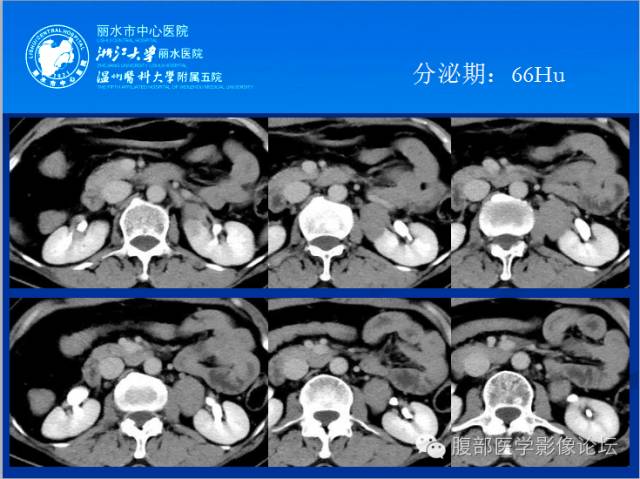 【病例】肾平滑肌瘤1例CT影像表现 【病例】肾平滑肌瘤1例CT影像表现