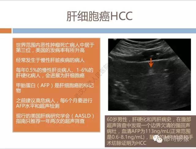 【PPT】放射科医生应知道的常用腹盆部肿瘤标记物