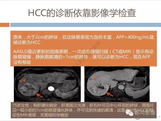 【PPT】放射科医生应知道的常用腹盆部肿瘤标记物