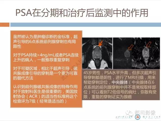 【PPT】放射科医生应知道的常用腹盆部肿瘤标记物