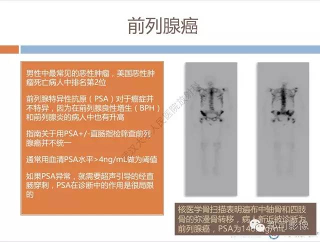 【PPT】放射科医生应知道的常用腹盆部肿瘤标记物