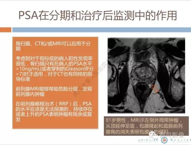 【PPT】放射科医生应知道的常用腹盆部肿瘤标记物