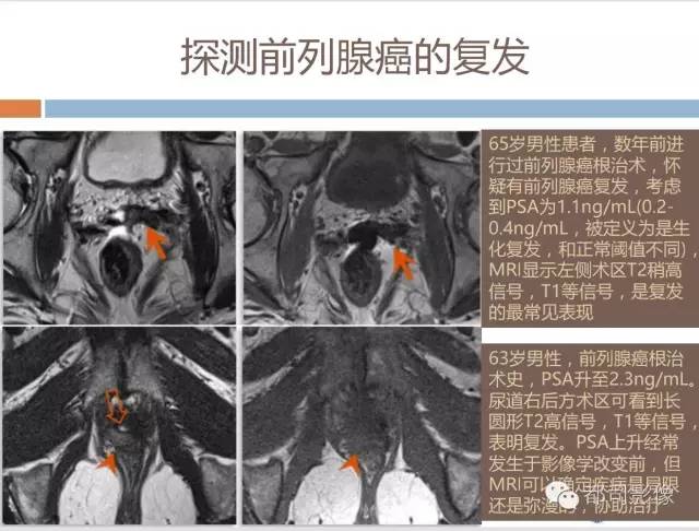 【PPT】放射科医生应知道的常用腹盆部肿瘤标记物