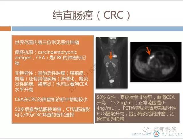【PPT】放射科医生应知道的常用腹盆部肿瘤标记物