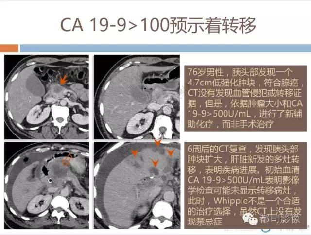 【PPT】放射科医生应知道的常用腹盆部肿瘤标记物