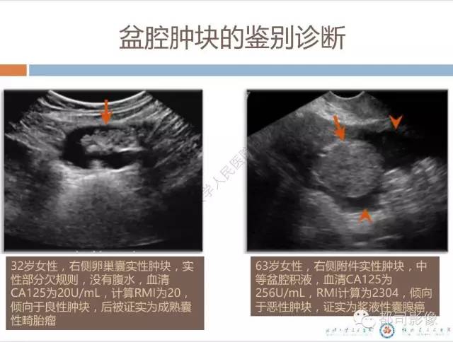 【PPT】放射科医生应知道的常用腹盆部肿瘤标记物