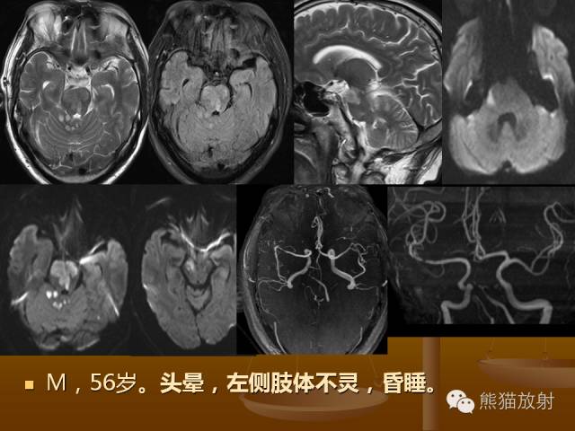 【PPT】脑梗死及相关改变MRI表现