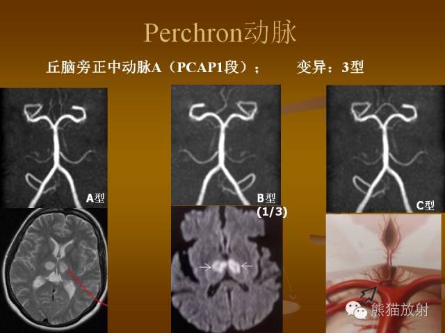 【PPT】脑梗死及相关改变MRI表现