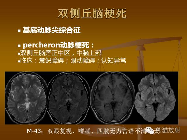 【PPT】脑梗死及相关改变MRI表现