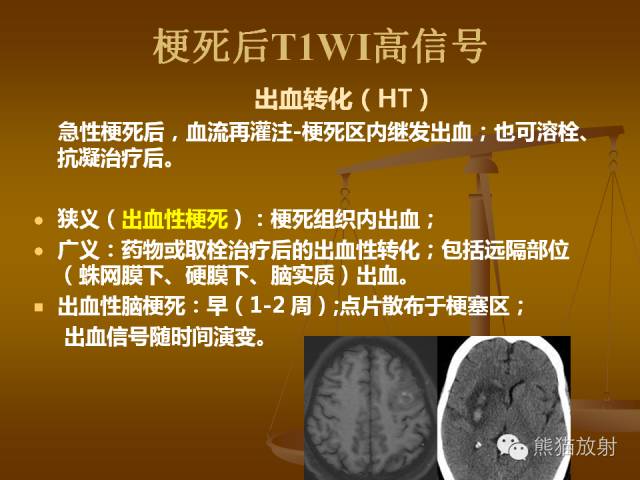 【PPT】脑梗死及相关改变MRI表现