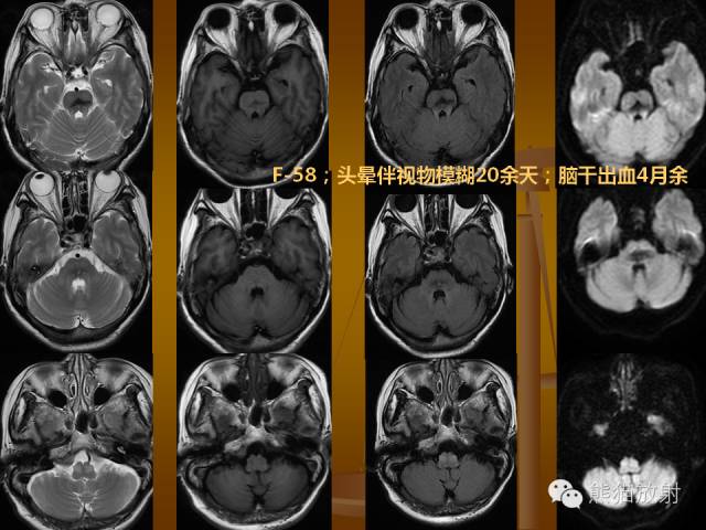 【PPT】脑梗死及相关改变MRI表现