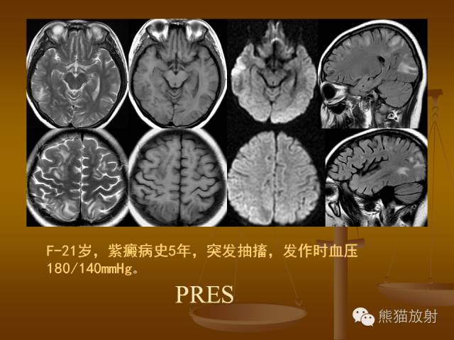 【PPT】脑梗死及相关改变MRI表现