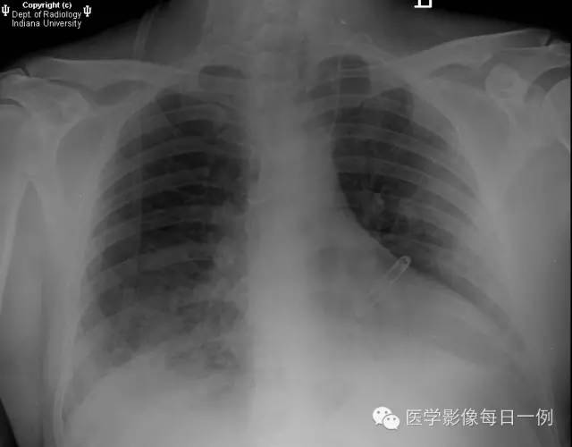 【病例】肺泡性出血1例X线CT影像表现