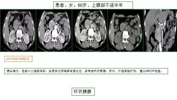 【病例】环状胰腺1例CT影像讨论 【病例】环状胰腺1例CT影像讨论