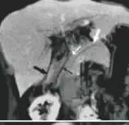 【病例】环状胰腺1例CT影像讨论 【病例】环状胰腺1例CT影像讨论