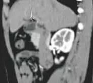 【病例】环状胰腺1例CT影像讨论 【病例】环状胰腺1例CT影像讨论