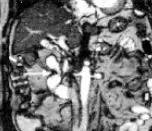 【病例】环状胰腺1例CT影像讨论 【病例】环状胰腺1例CT影像讨论