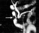 【病例】环状胰腺1例CT影像讨论 【病例】环状胰腺1例CT影像讨论