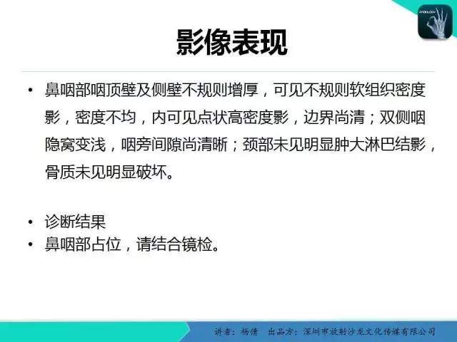 【病例】鼻咽部淋巴组织增生性炎症1例CT及MR