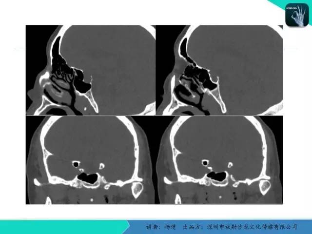 【病例】鼻咽部淋巴组织增生性炎症1例CT及MR