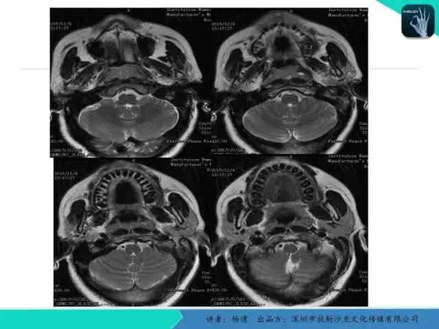 【病例】鼻咽部淋巴组织增生性炎症1例CT及MR