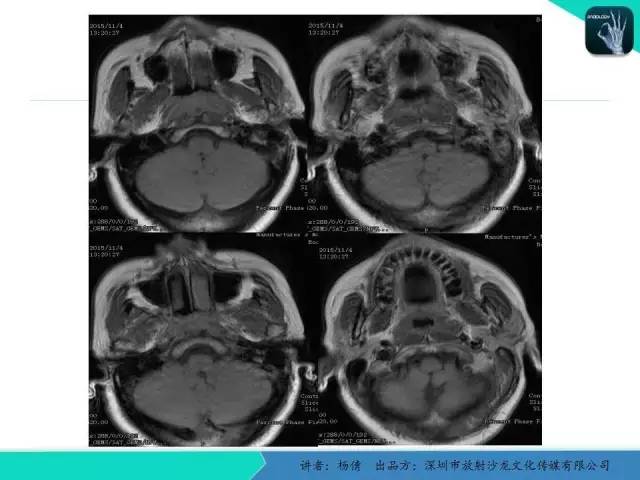【病例】鼻咽部淋巴组织增生性炎症1例CT及MR