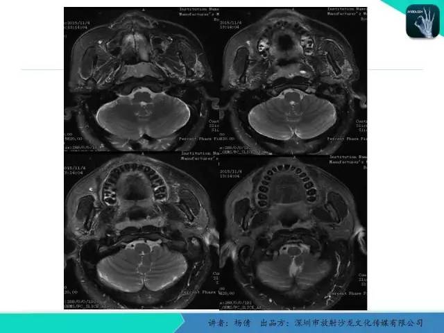【病例】鼻咽部淋巴组织增生性炎症1例CT及MR