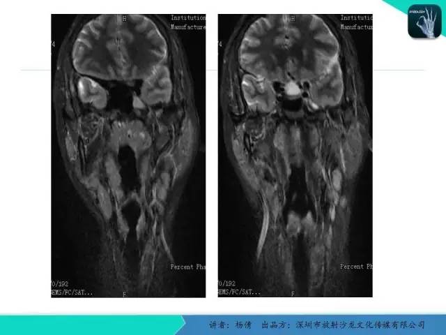 【病例】鼻咽部淋巴组织增生性炎症1例CT及MR