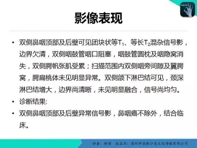 【病例】鼻咽部淋巴组织增生性炎症1例CT及MR