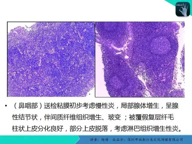 【病例】鼻咽部淋巴组织增生性炎症1例CT及MR