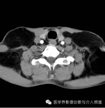 【病例】马德隆病(良性对称性脂肪瘤病)1例CT