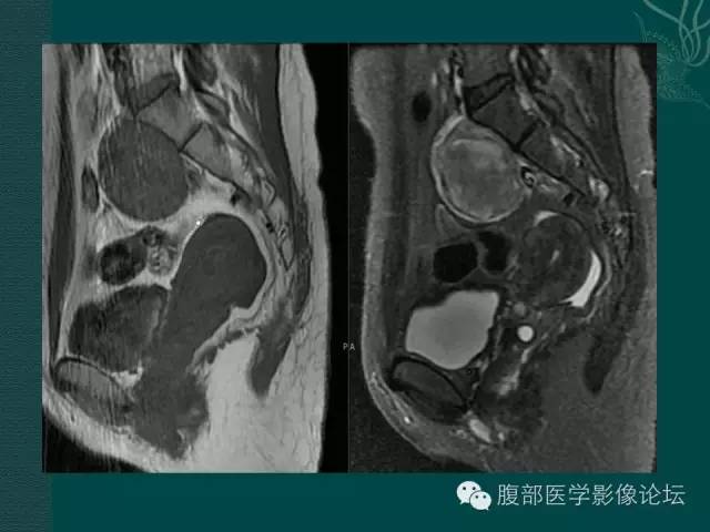 【病例】腹膜后神经鞘瘤1例MR影像表现