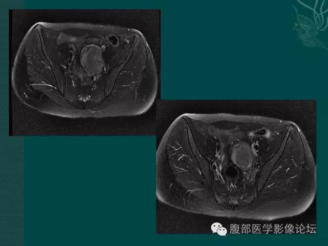 【病例】腹膜后神经鞘瘤1例MR影像表现