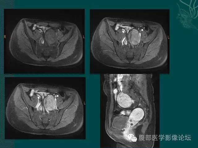 【病例】腹膜后神经鞘瘤1例MR影像表现