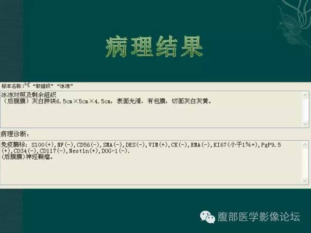 【病例】腹膜后神经鞘瘤1例MR影像表现