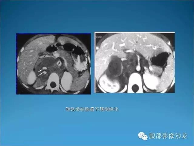 【病例】腹膜后神经鞘瘤1例MR影像表现