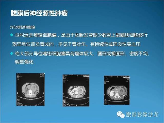 【病例】腹膜后神经鞘瘤1例MR影像表现