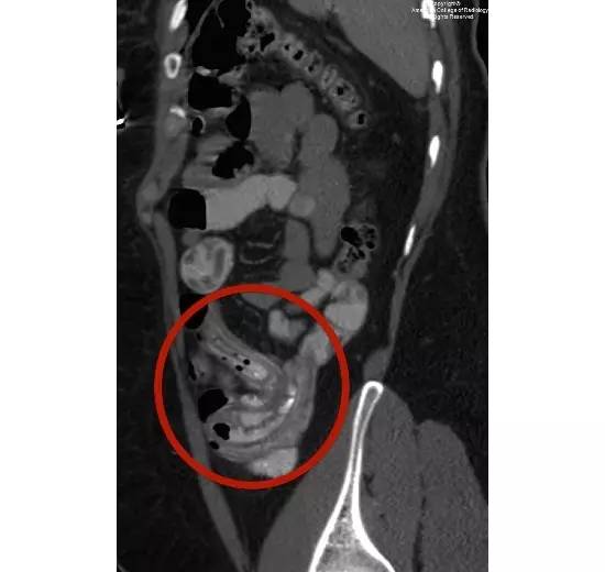 【病例】肠道寄生虫1例CT影像表现 【病例】肠道寄生虫1例CT影像表现